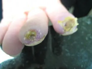 SCLERODERMA