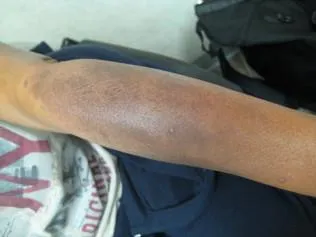 SCLERODERMA