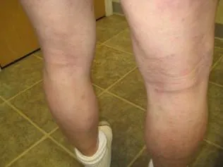 SCLERODERMA