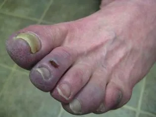 SCLERODERMA