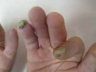 SCLERODERMA