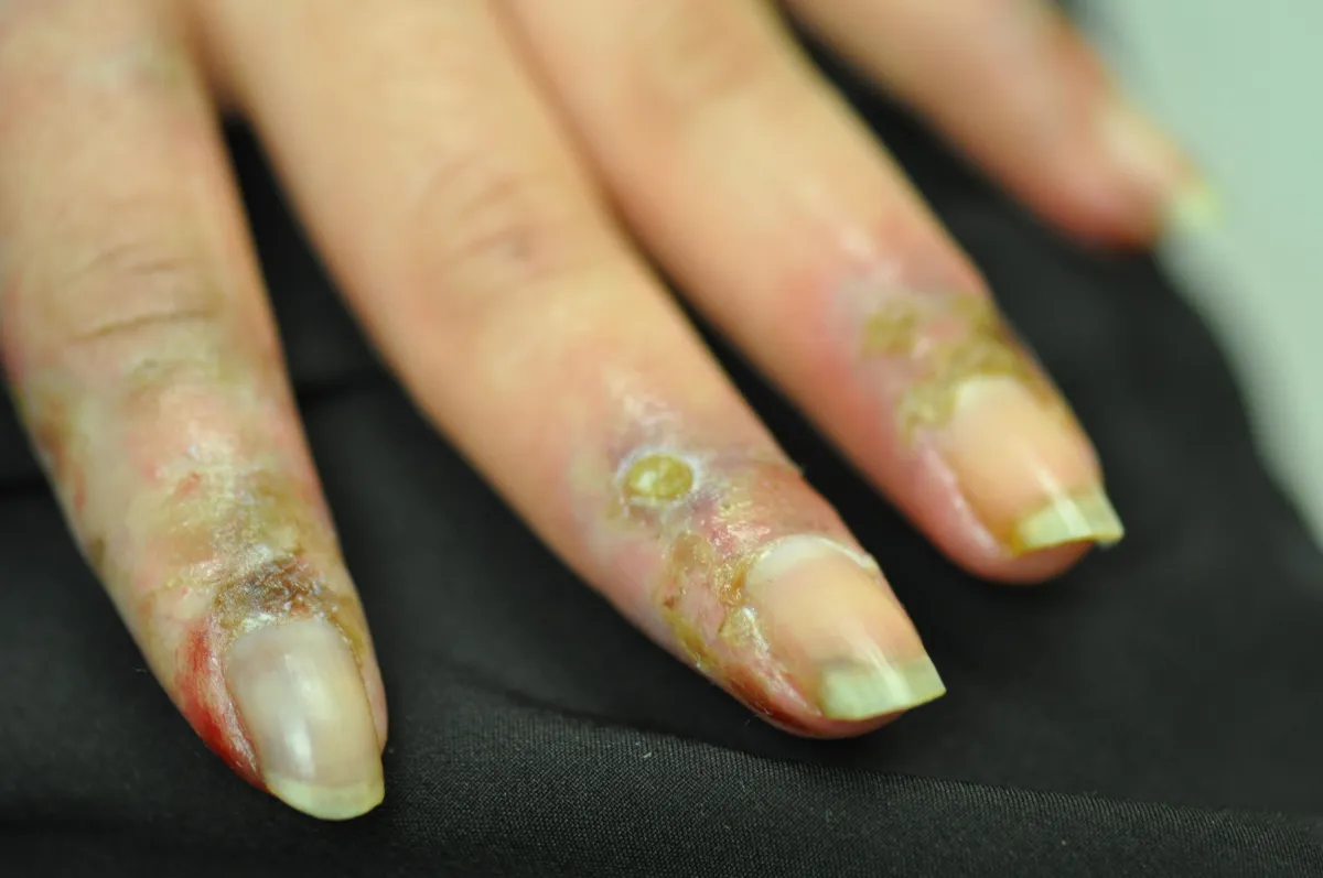 SCLERODERMA
