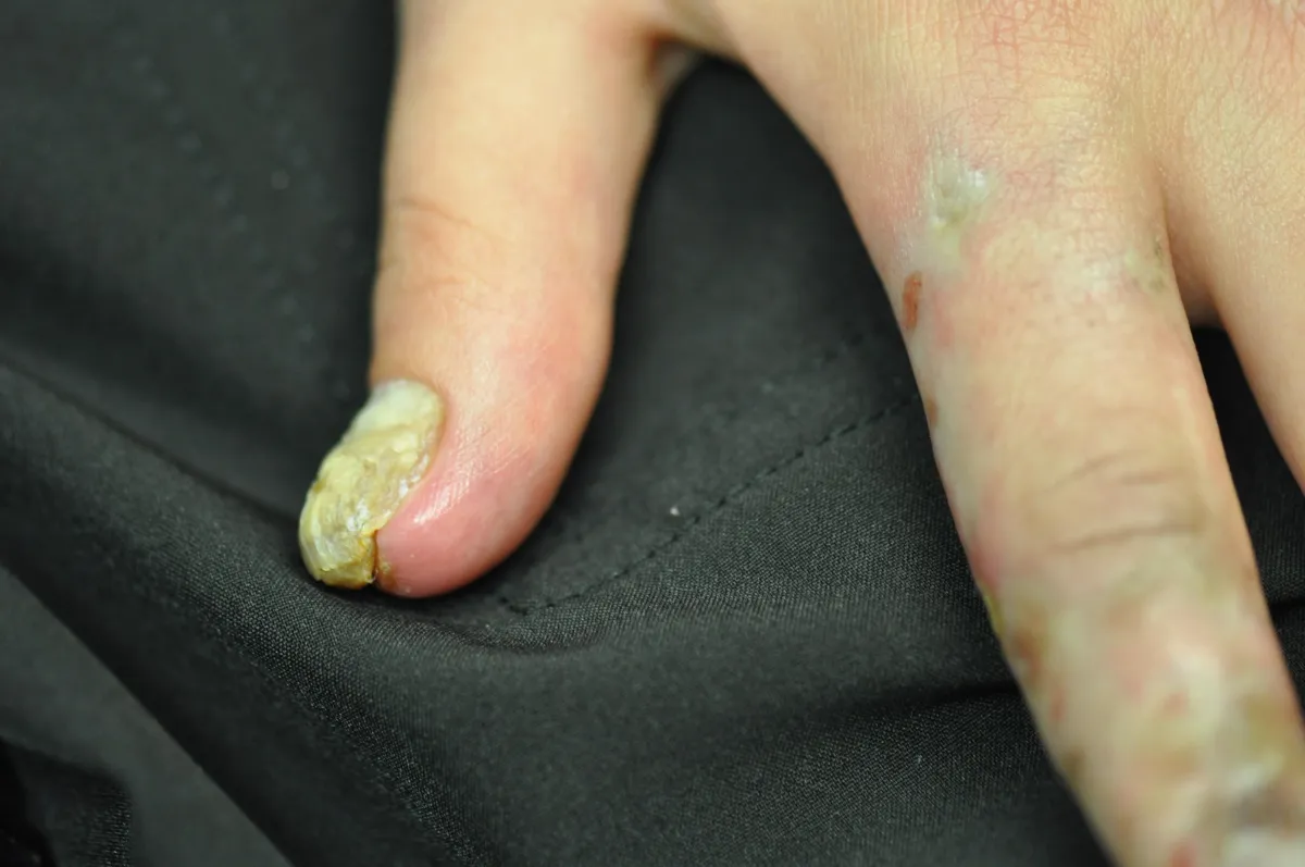 SCLERODERMA