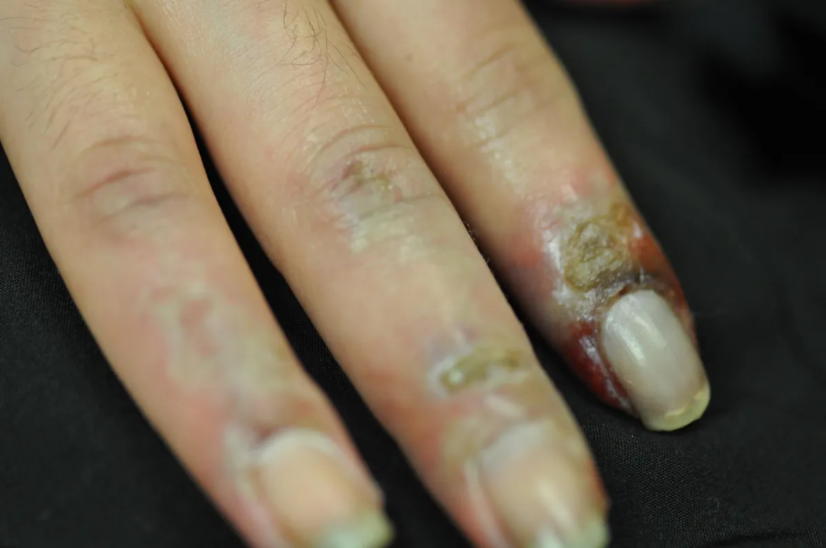 SCLERODERMA