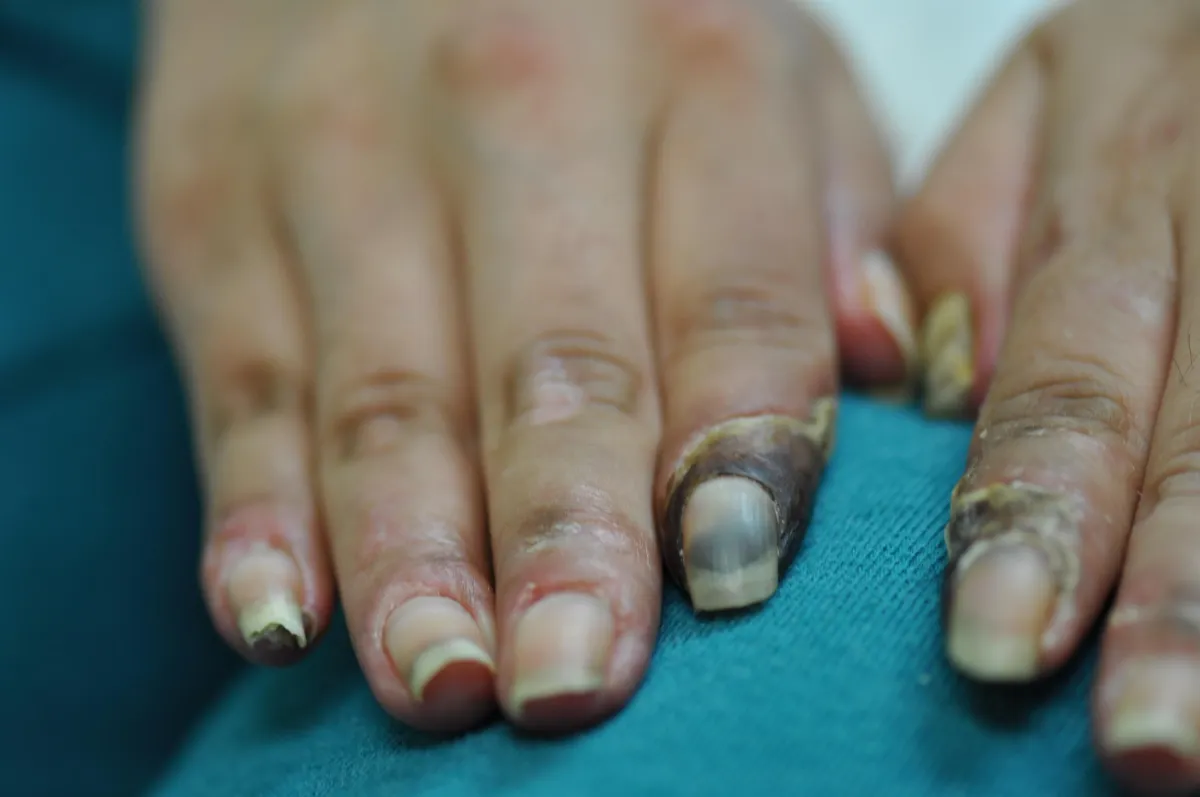 SCLERODERMA