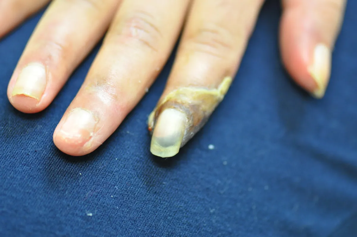 SCLERODERMA