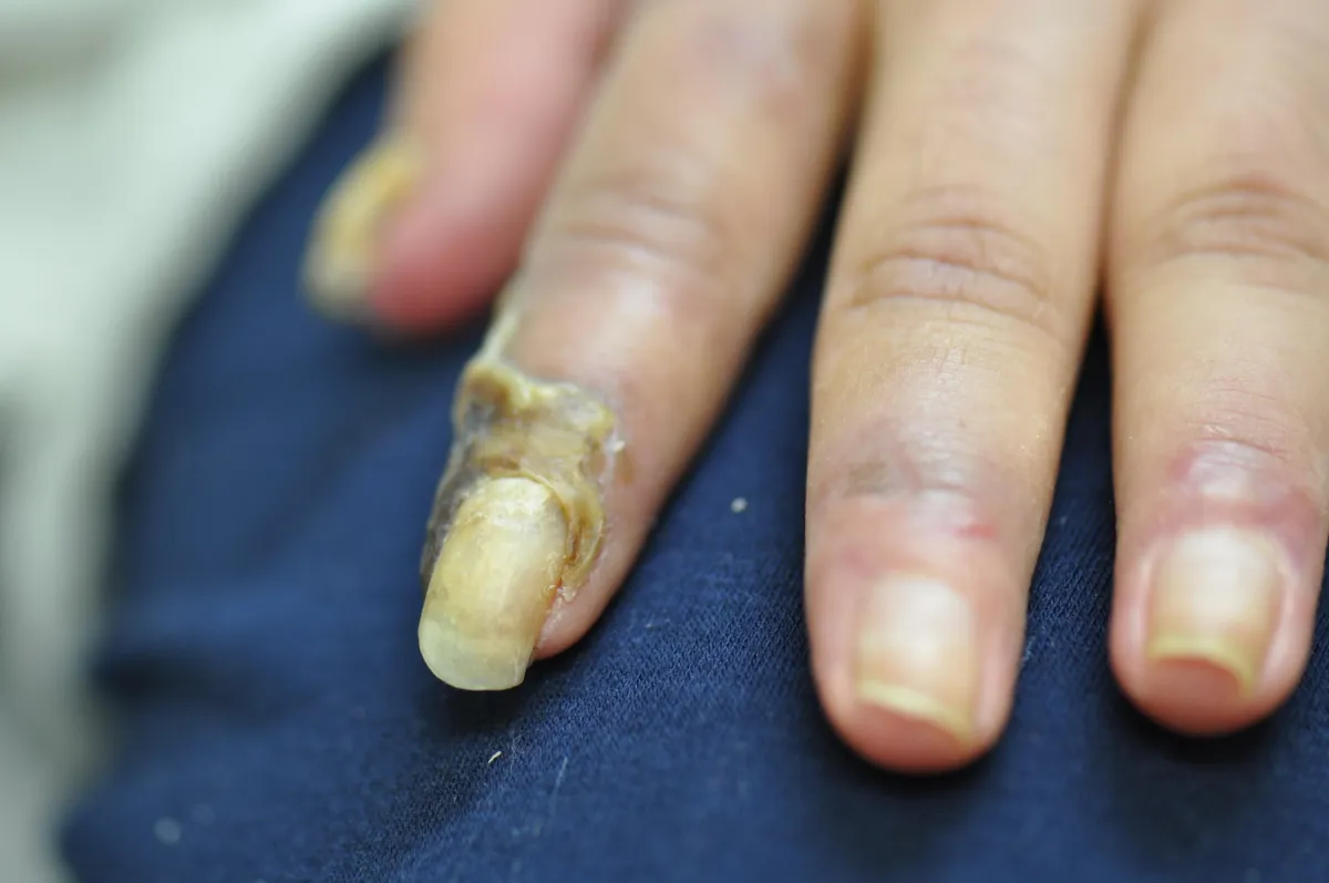 SCLERODERMA