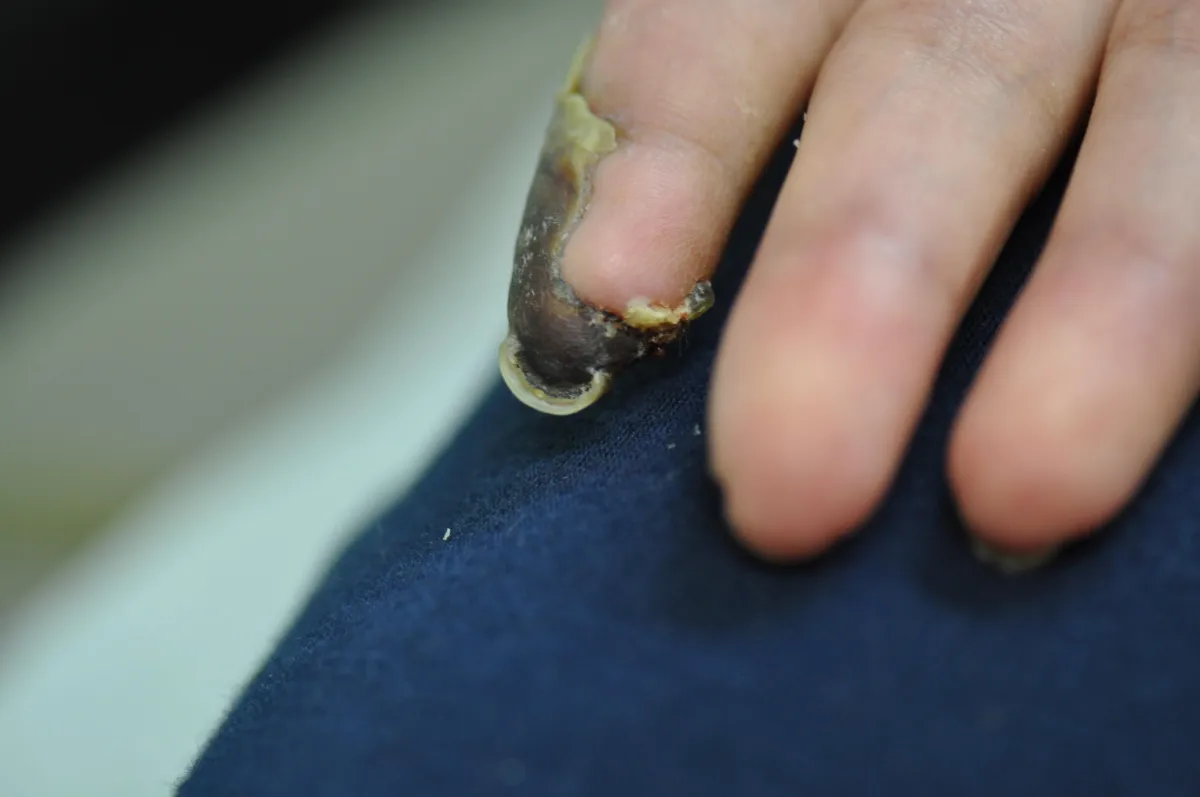 SCLERODERMA