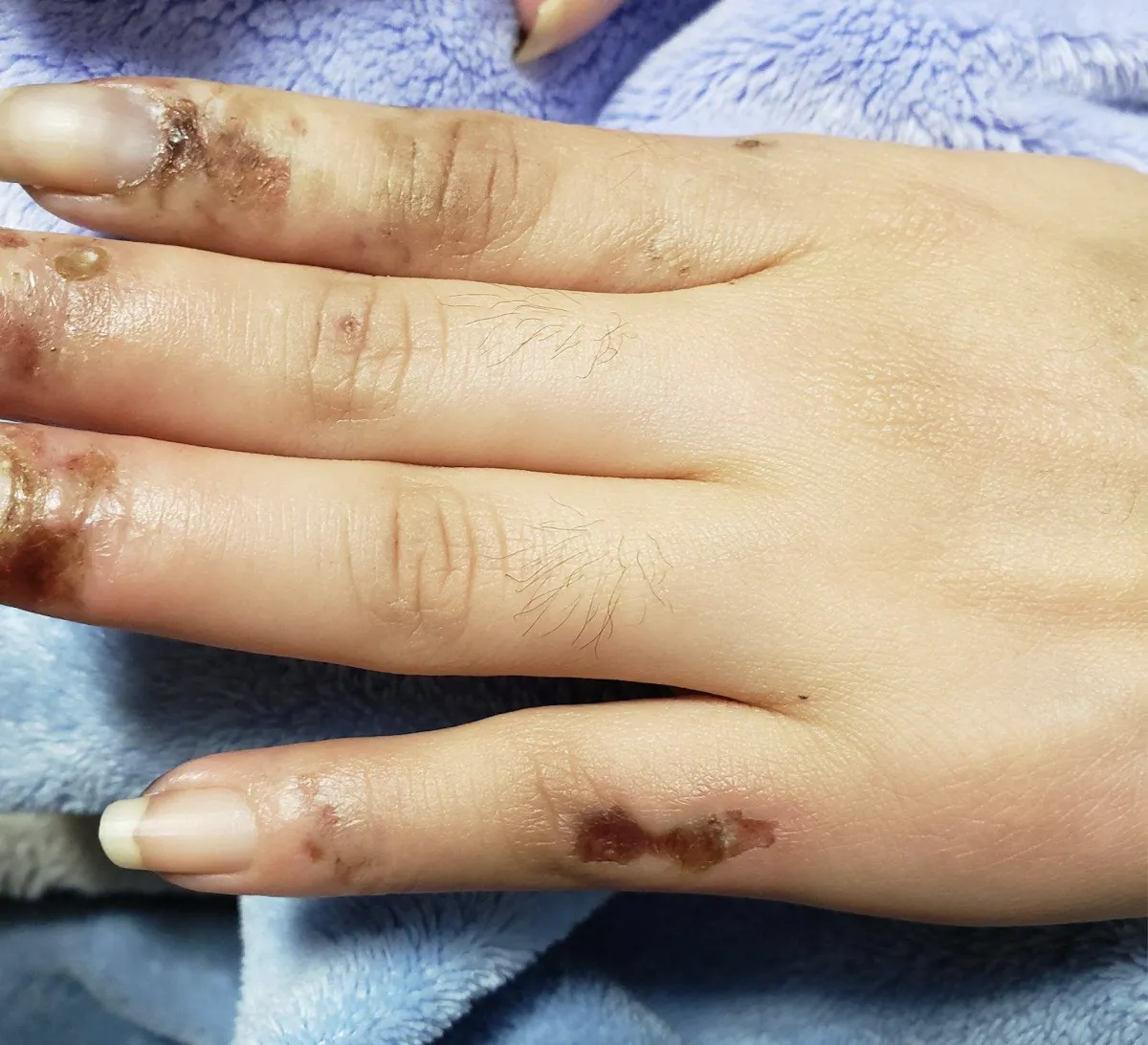 PSORIATIC ARTHRITIS