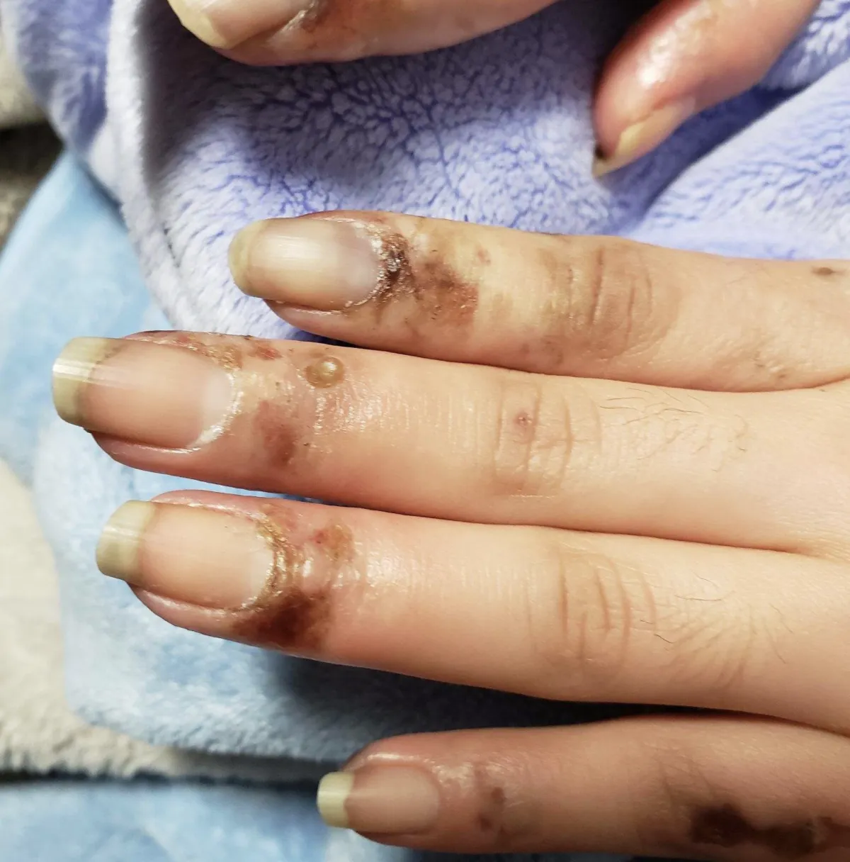 PSORIATIC ARTHRITIS