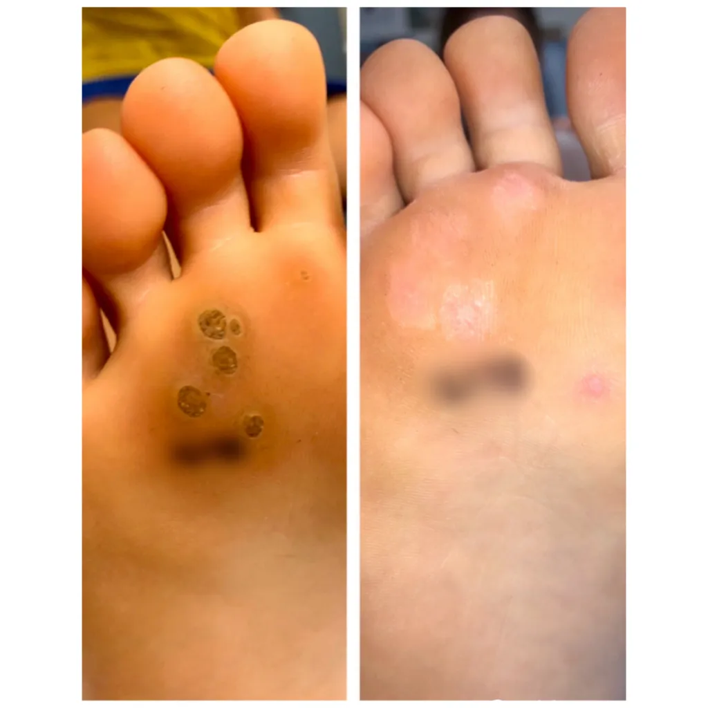 Plantar Wart Removal USA