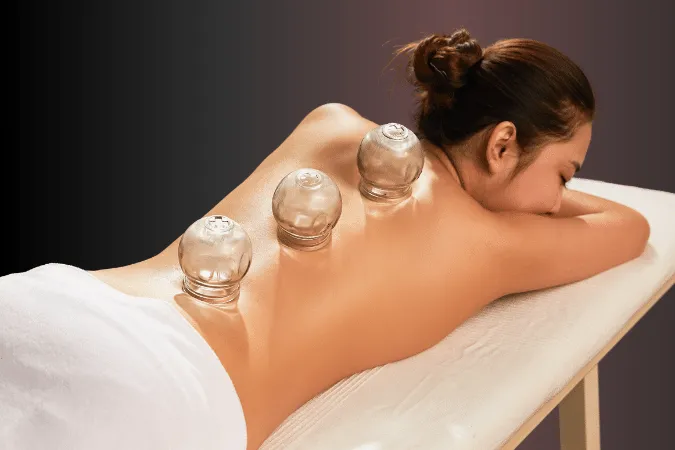 A woman rests with 3 therapeutic cups applied along her spine.