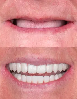 Full Arch Implant