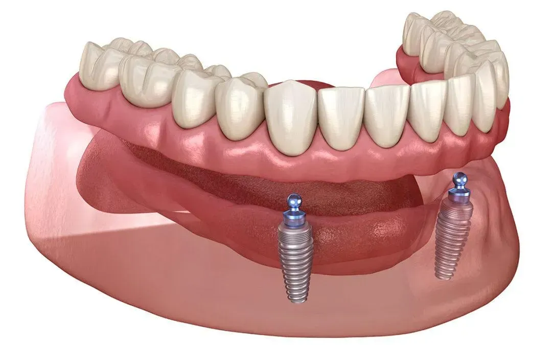 Smiling patient after treatment with best implant dentist Dr. Mati DDS