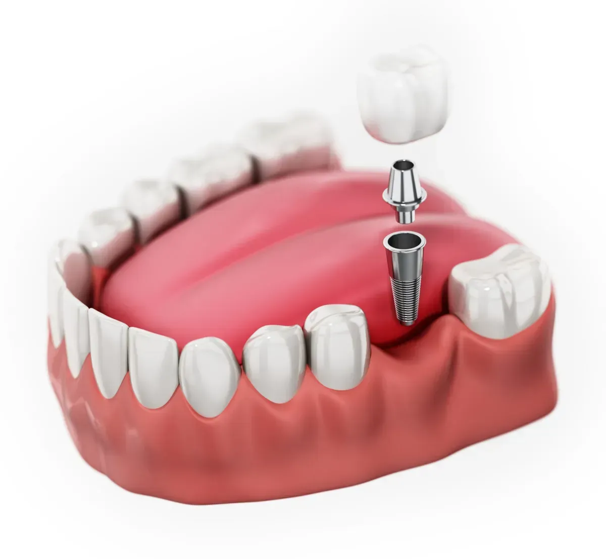 Best implant dentist Franklin MI | Team of dental professionals at work / Dr. Rita Bano | Advanced Dentistry Center