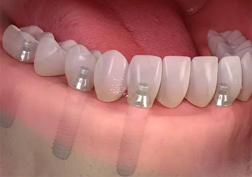 Tooth replacement surgery Southfield MI | Surgeon preparing for guided implant procedure / Dr. Mati DDS | Advanced Dentistry Center