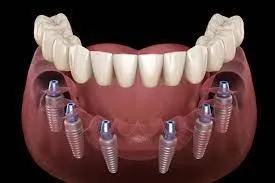 Full mouth dental implant model and treatment illustration by Dr. Mati DDS