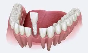oral surgery for dental implants by Dr. Rita Bano