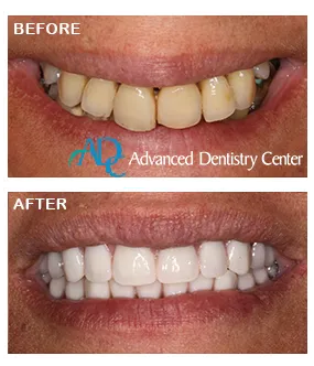 Dental implants Beverly Hills MI | Before & After comparison of implant types | Advanced Dentistry Center
