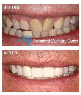 Experienced implant specialist Farmington Hills MI | Expert discussing full mouth restoration plan / Dr. Mati DDS | Advanced Dentistry Center