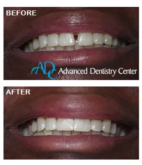 Affordable dental implants Royal Oak MI | Implant cost breakdown chart displayed / Dr. Rita Bano | Advanced Dentistry Center