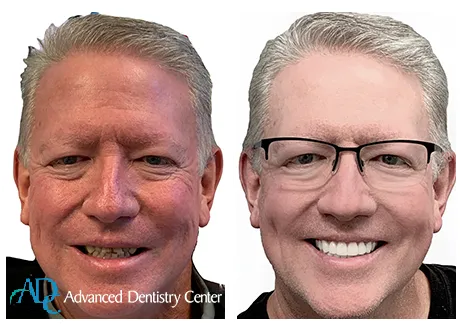 Prosthodontics Farmington Hills MI | Advanced dental prosthetics display / Dr. Rita Bano | Advanced Dentistry Center