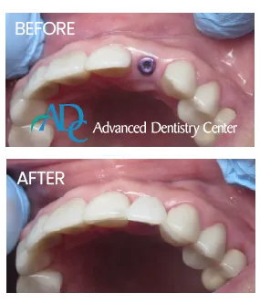 One-on-one implant consultation session with Dr. Mati DDS