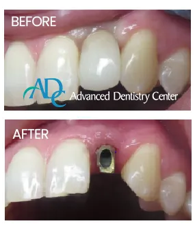 Implant dentistry tools and consultation scene by Dr. Rita Bano
