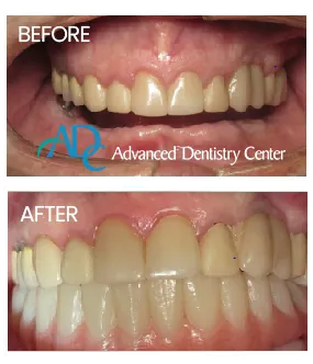Implant consultation near me Southfield MI | Patient learning about implant options / Dr. Rita Bano | Advanced Dentistry Center
