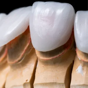 veneers