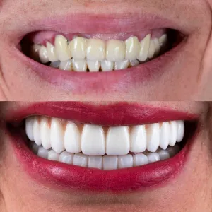 Smile Makeover