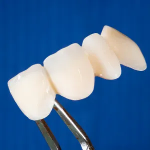 dental bridge