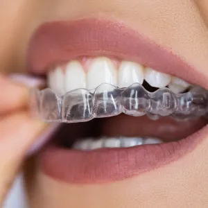 clear aligners