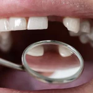 veneers