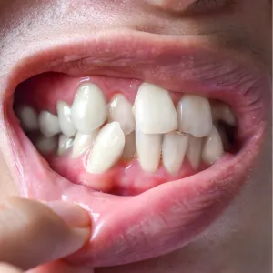 Smile Makeover