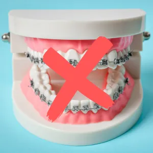 dental bridge