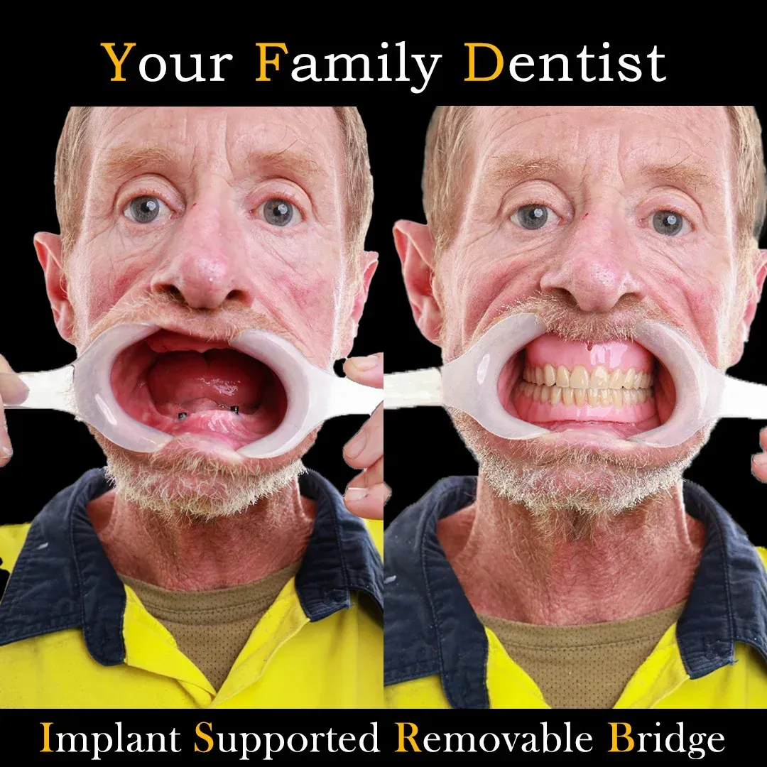 After dental implant treatment showing natural aligned teeth