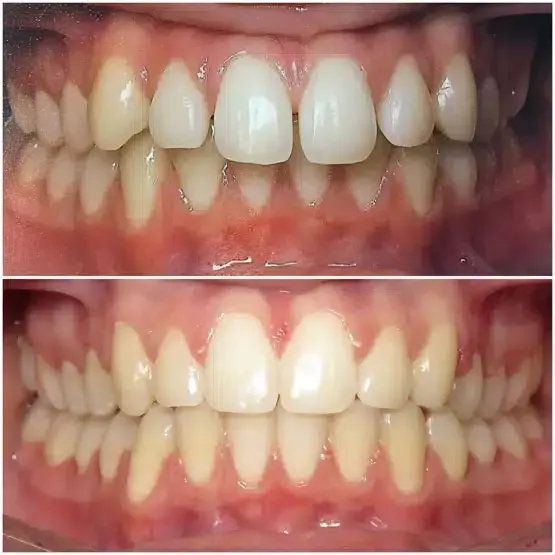 Before and after orthodontics treatment for James
