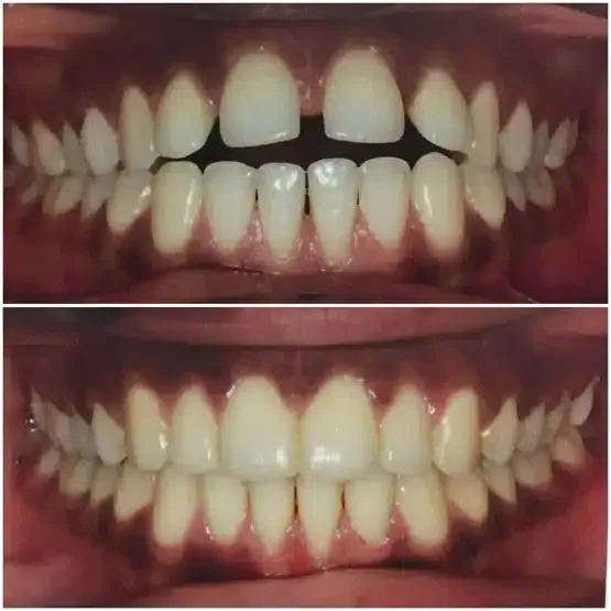 Before and after orthodontics treatment for David