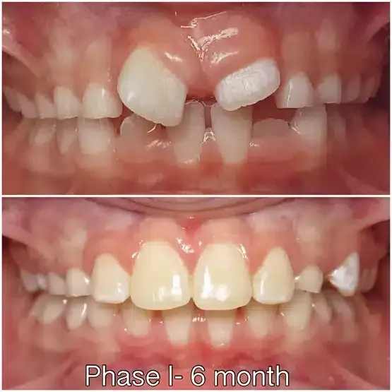 Before and after orthodontics treatment for Emma