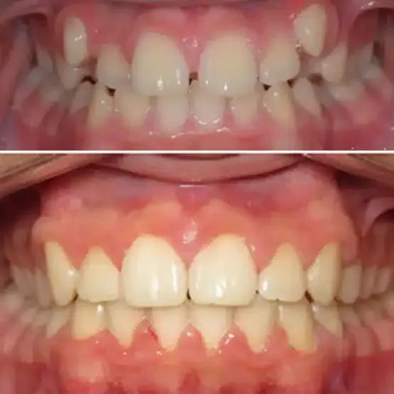 Before and after orthodontics treatment for Michael