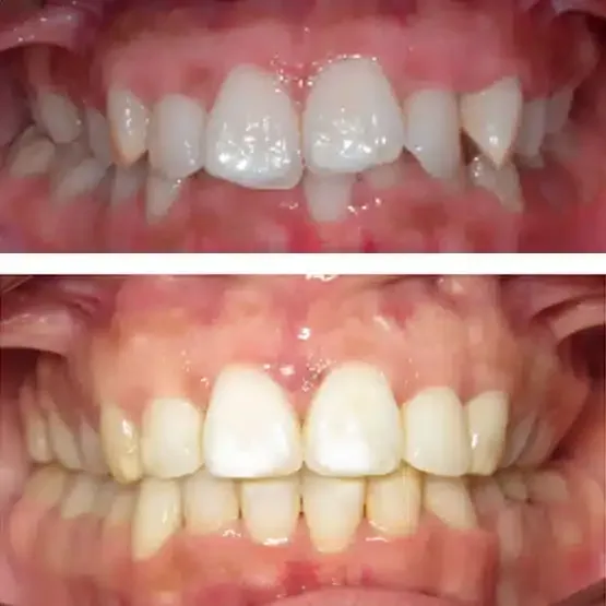 Before and after orthodontics treatment for Sarah