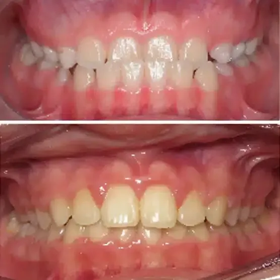 Before and after orthodontics treatment for Chloe