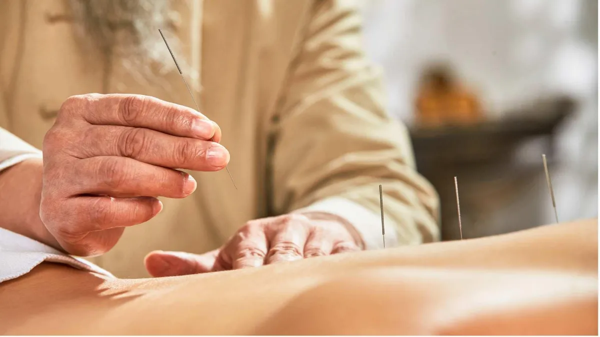 Acupuncture