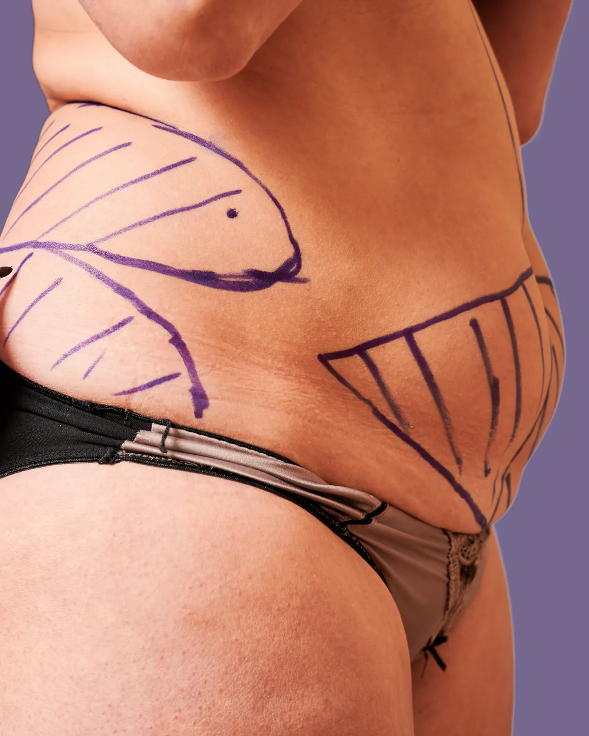 Abdomen with surgical markings for body contouring.