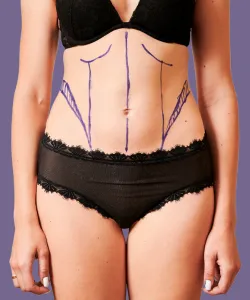 Close-up of a woman’s midsection with surgical markings showing target areas for post-bariatric body contouring.
