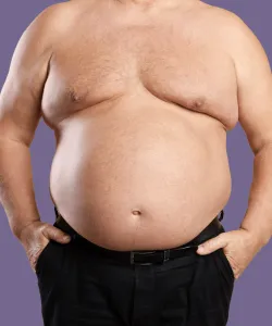 Woman before bariatric duodenal switch surgery.