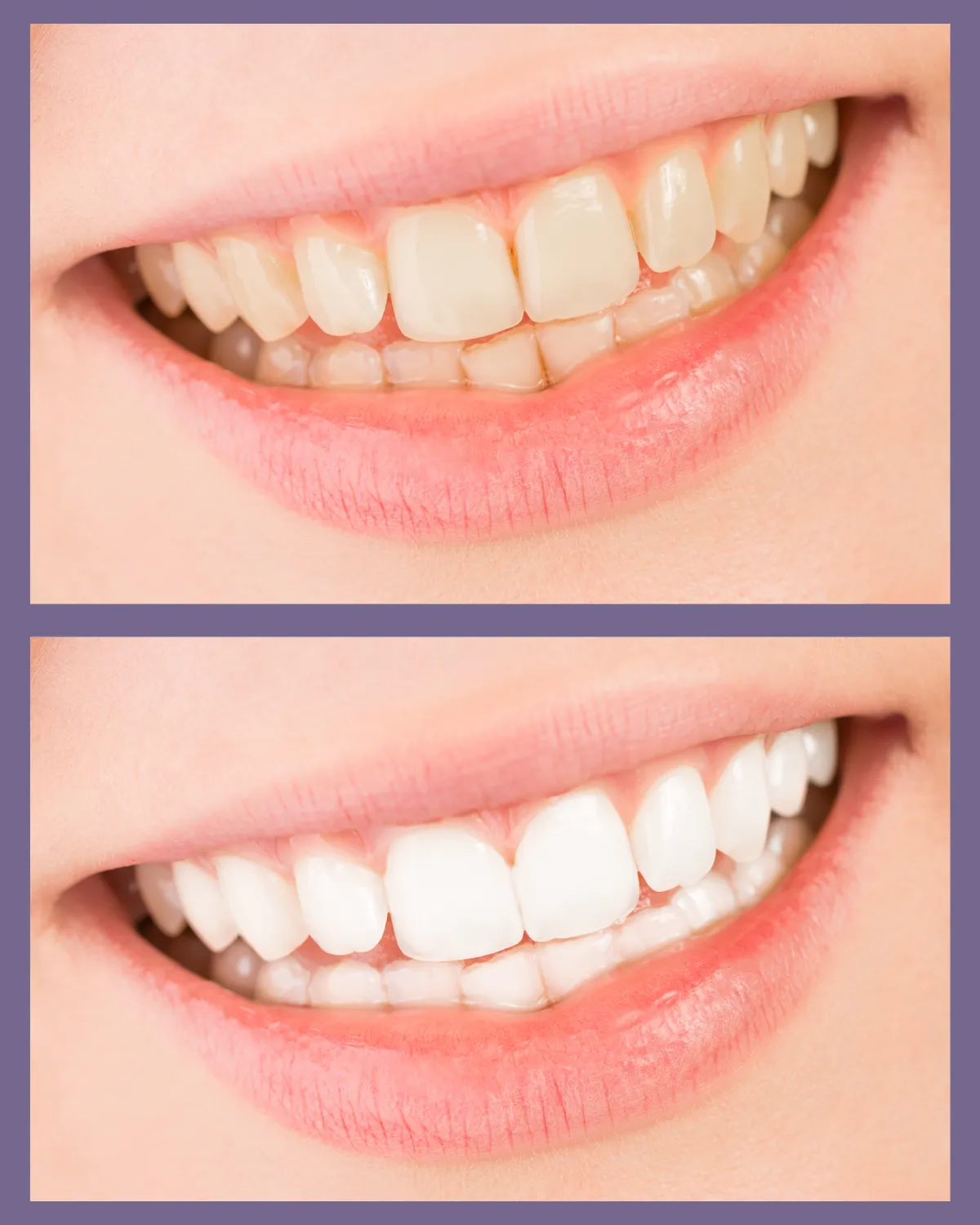 Close-up of bright smile of before and after professional teeth whitening dental surgery.