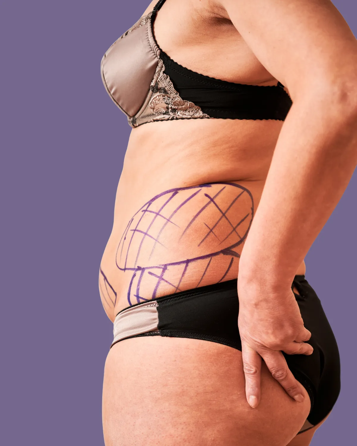 Woman’s midsection with surgical markings before post-bariatric body lift.