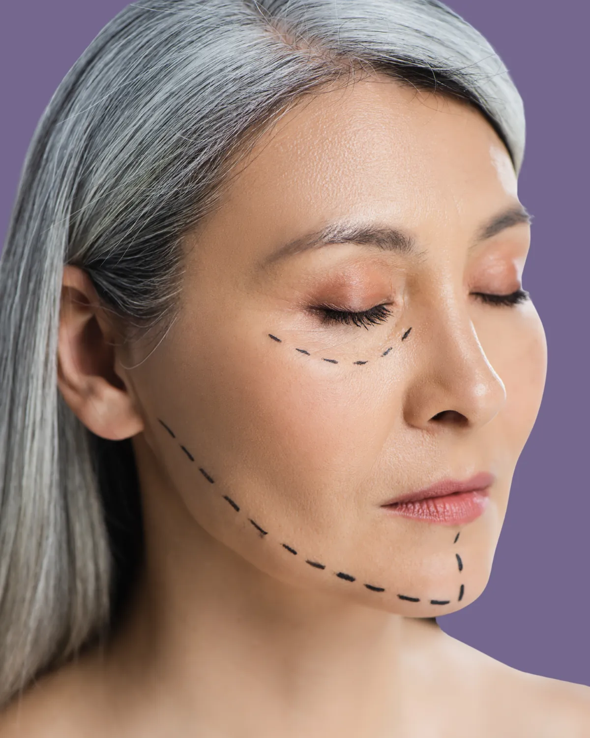 Woman with facial markings before facelift, highlighting anti-aging facial plastic surgery.